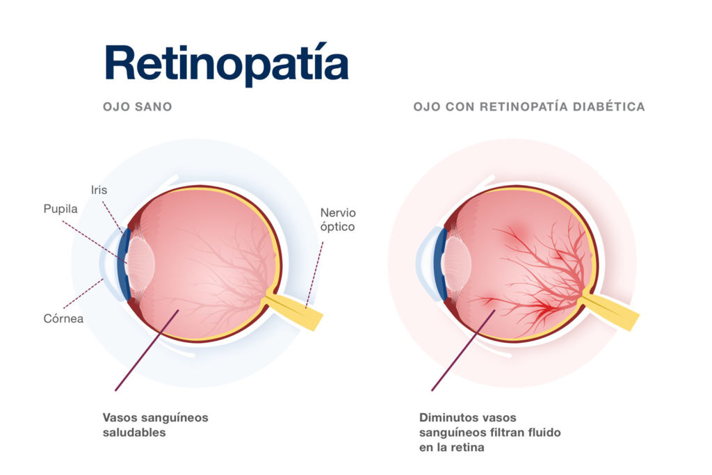 Retinopatia