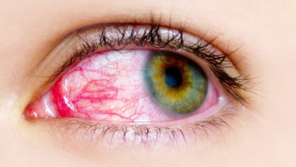 conjuntivitis ficha 1dee1e5c 1280x720
